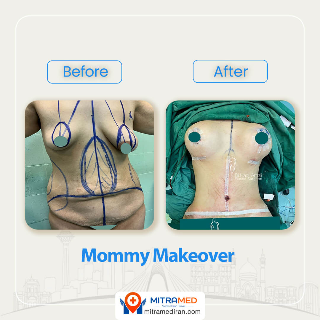 MOMMY MAKEOVER BEFORE AFTER