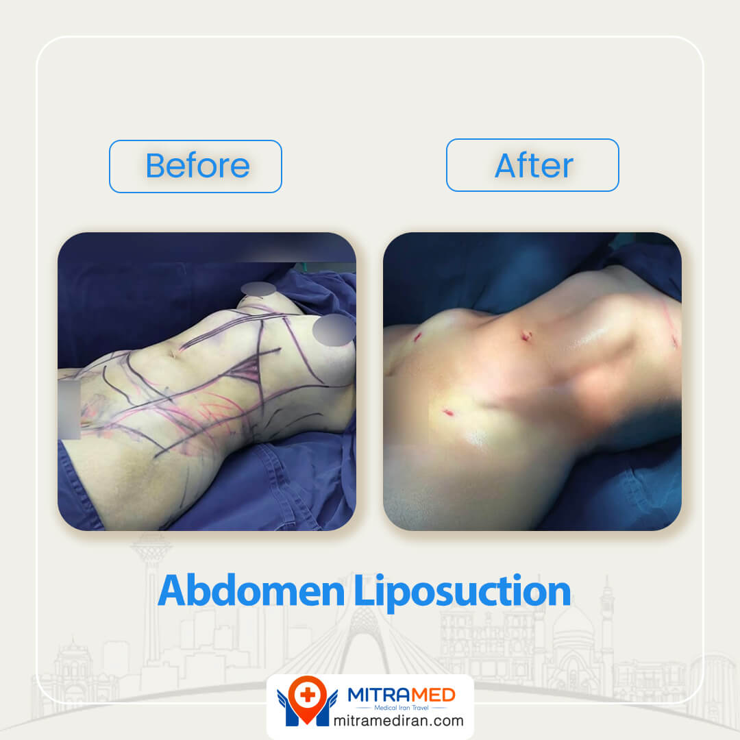 abdomen liposuction before after-1