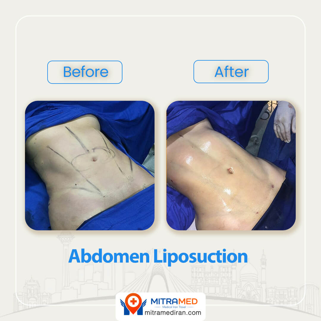 abdomen liposuction before after-2