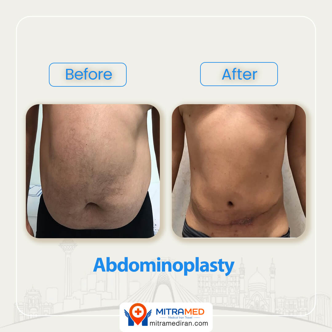 abdominoplasty before after-2