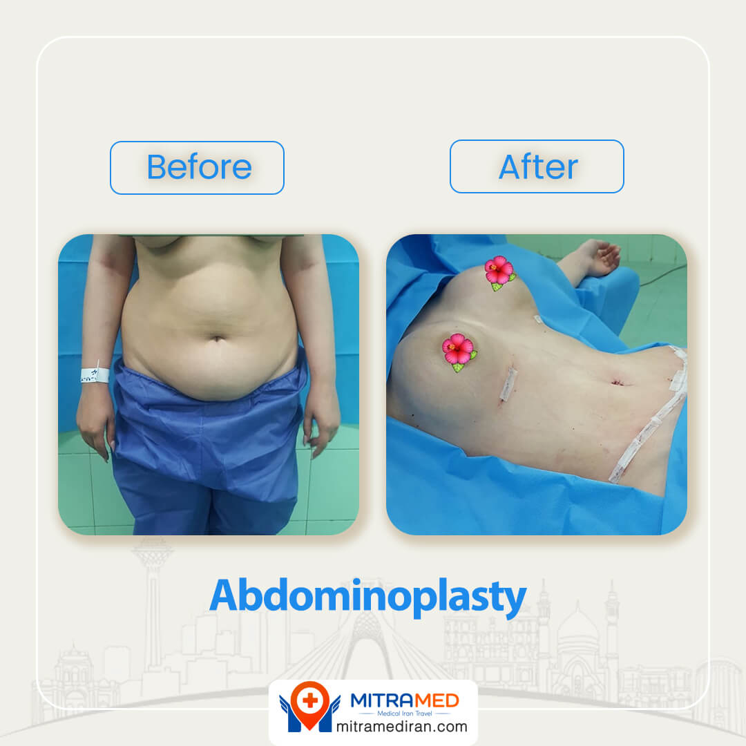 abdominoplasty before after-3