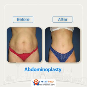 abdominoplsty before after-1