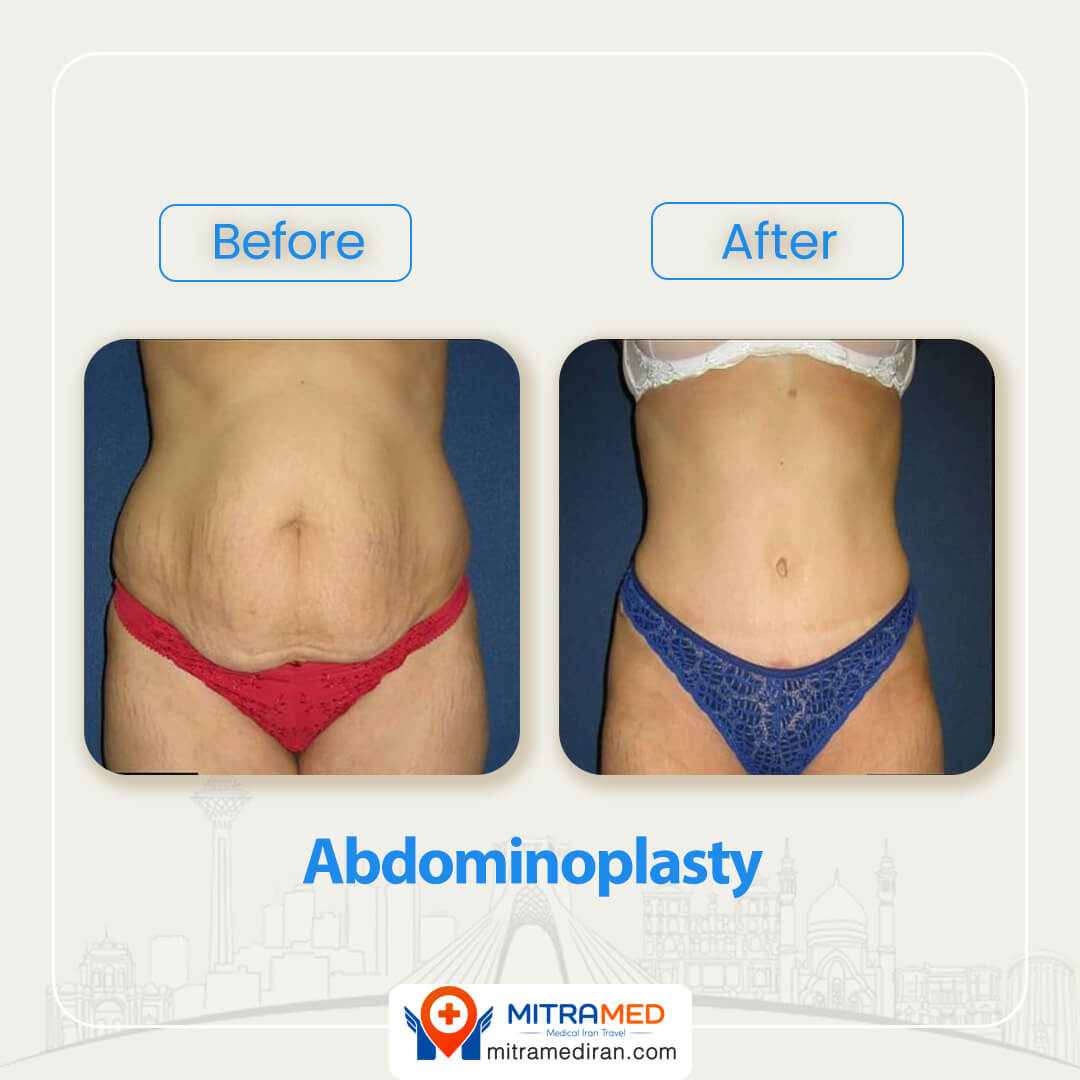 abdominoplsty before after-1