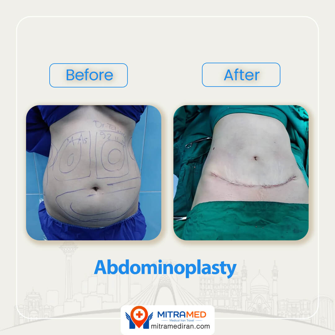 abdominoplsty before after-4