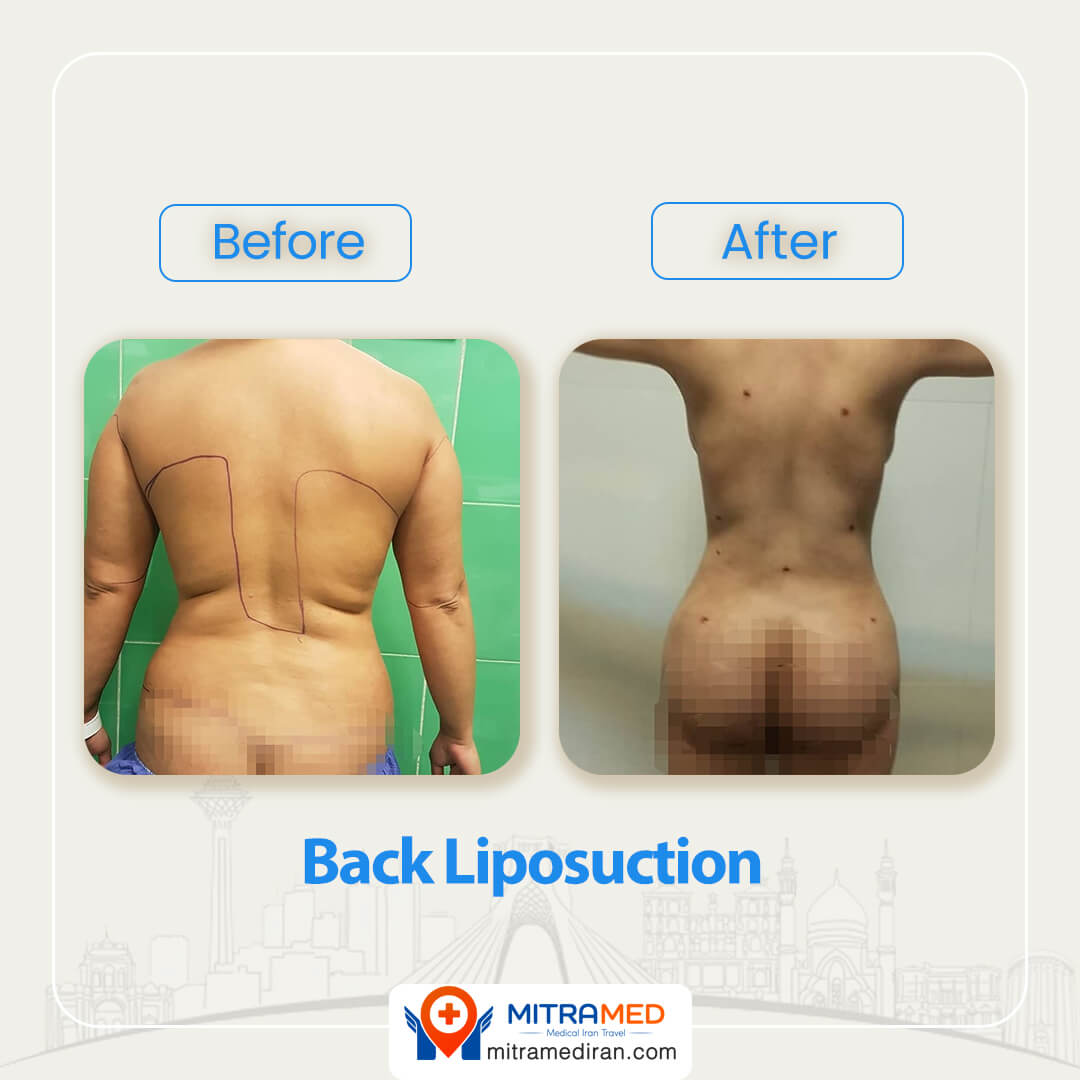 back liposuction before after