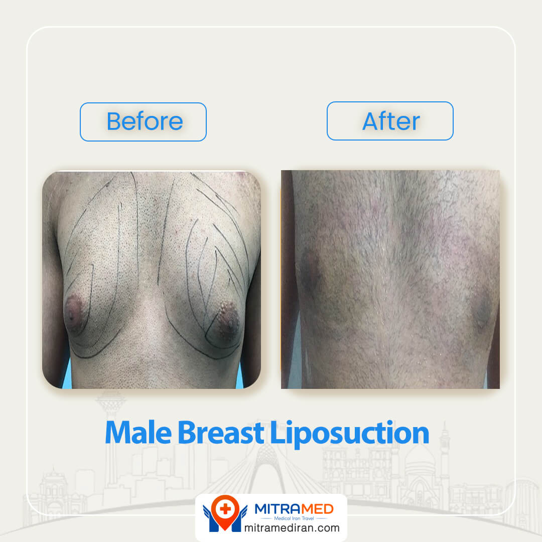 breast liposuction before after