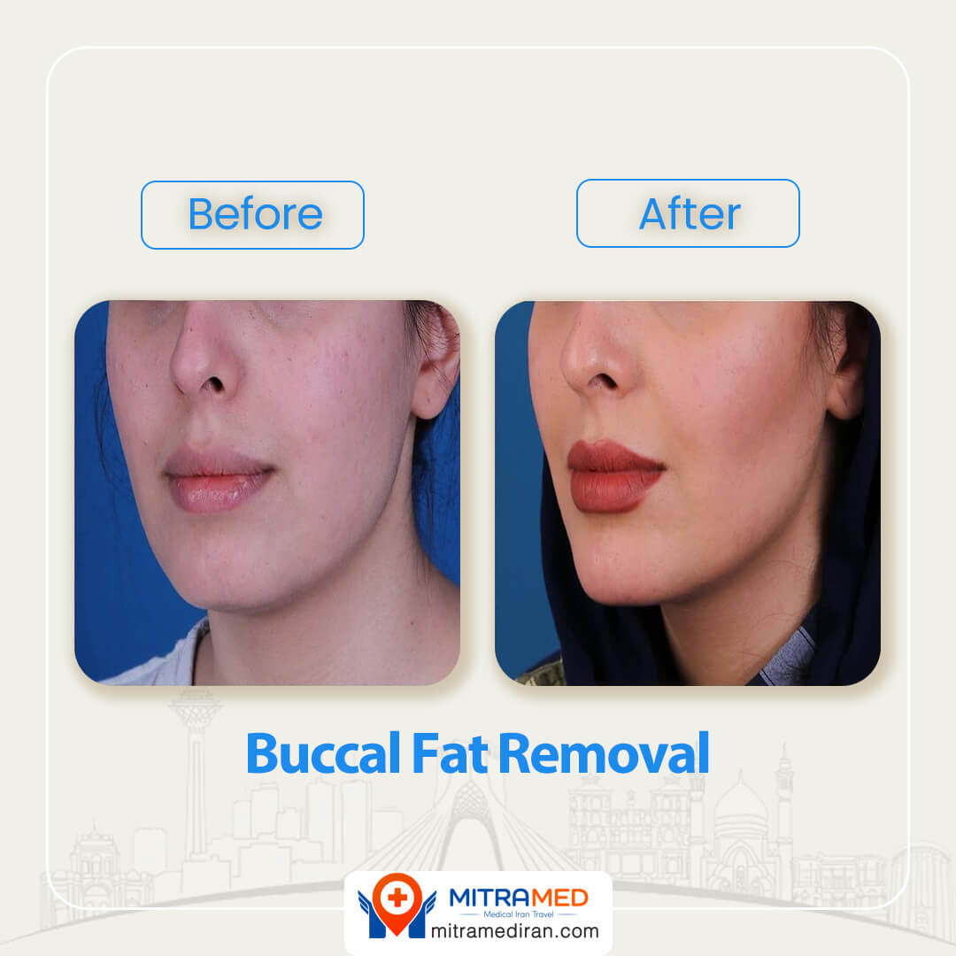 buccal fat removal before after-1