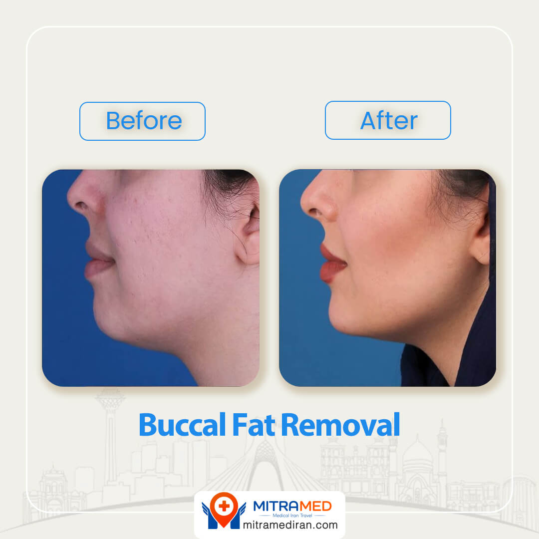 buccal fat removal before after-2