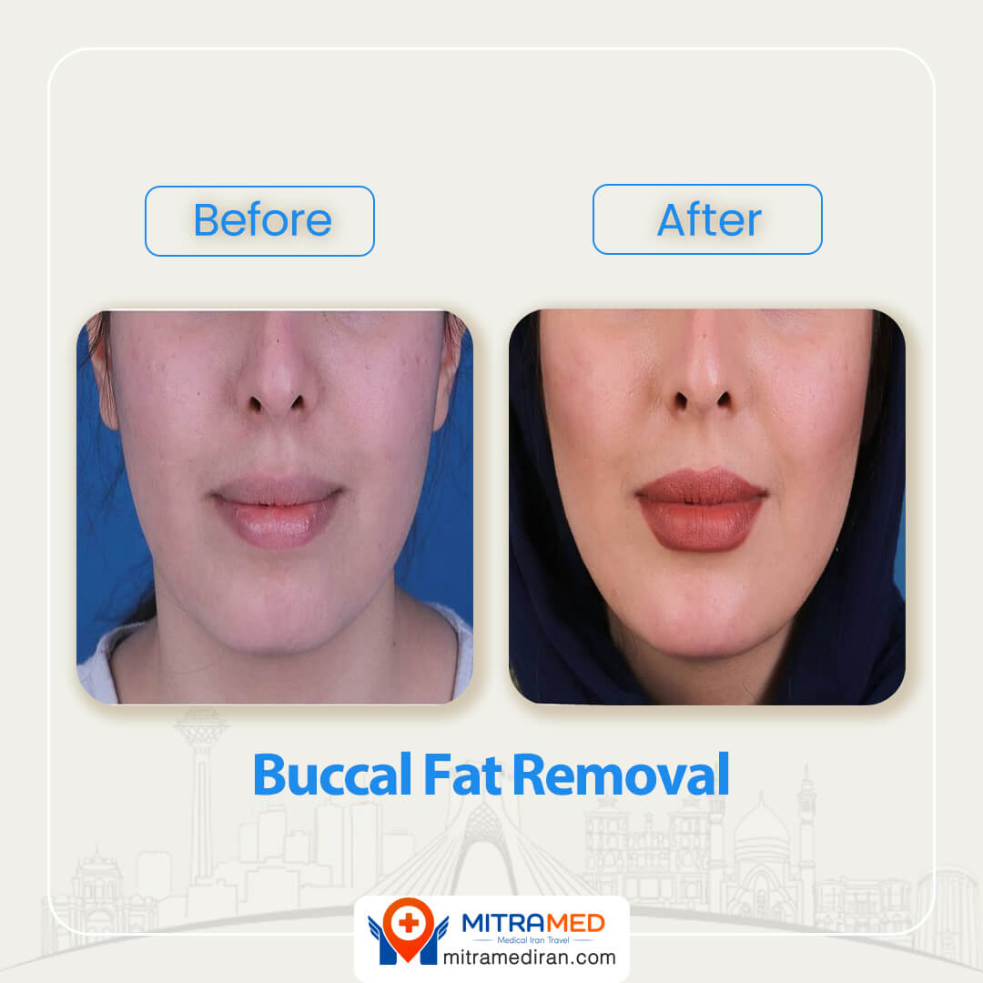 buccal fat removal before after-3