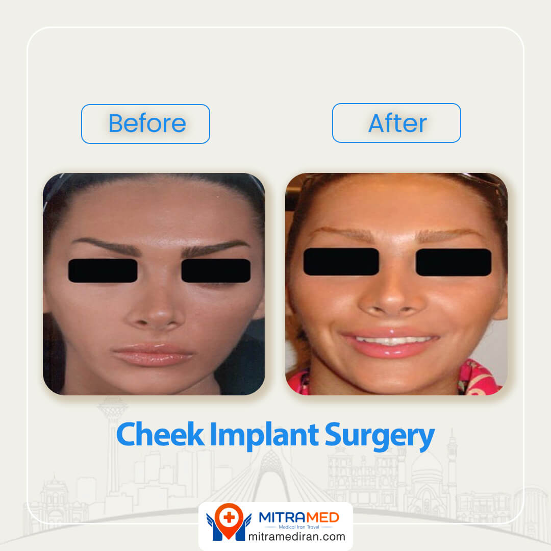 cheek implant before after-2