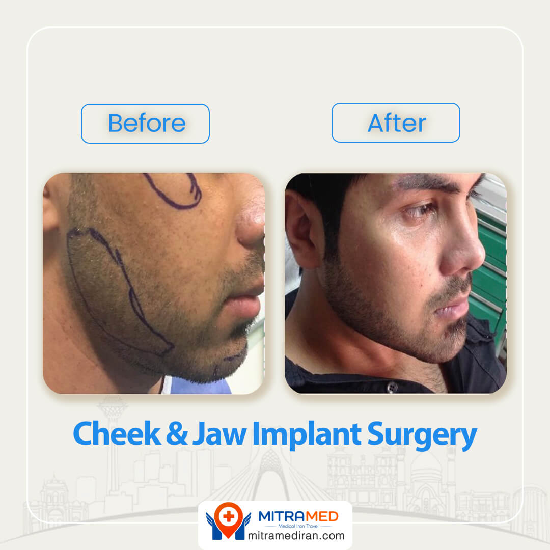 cheek implant before and after-1