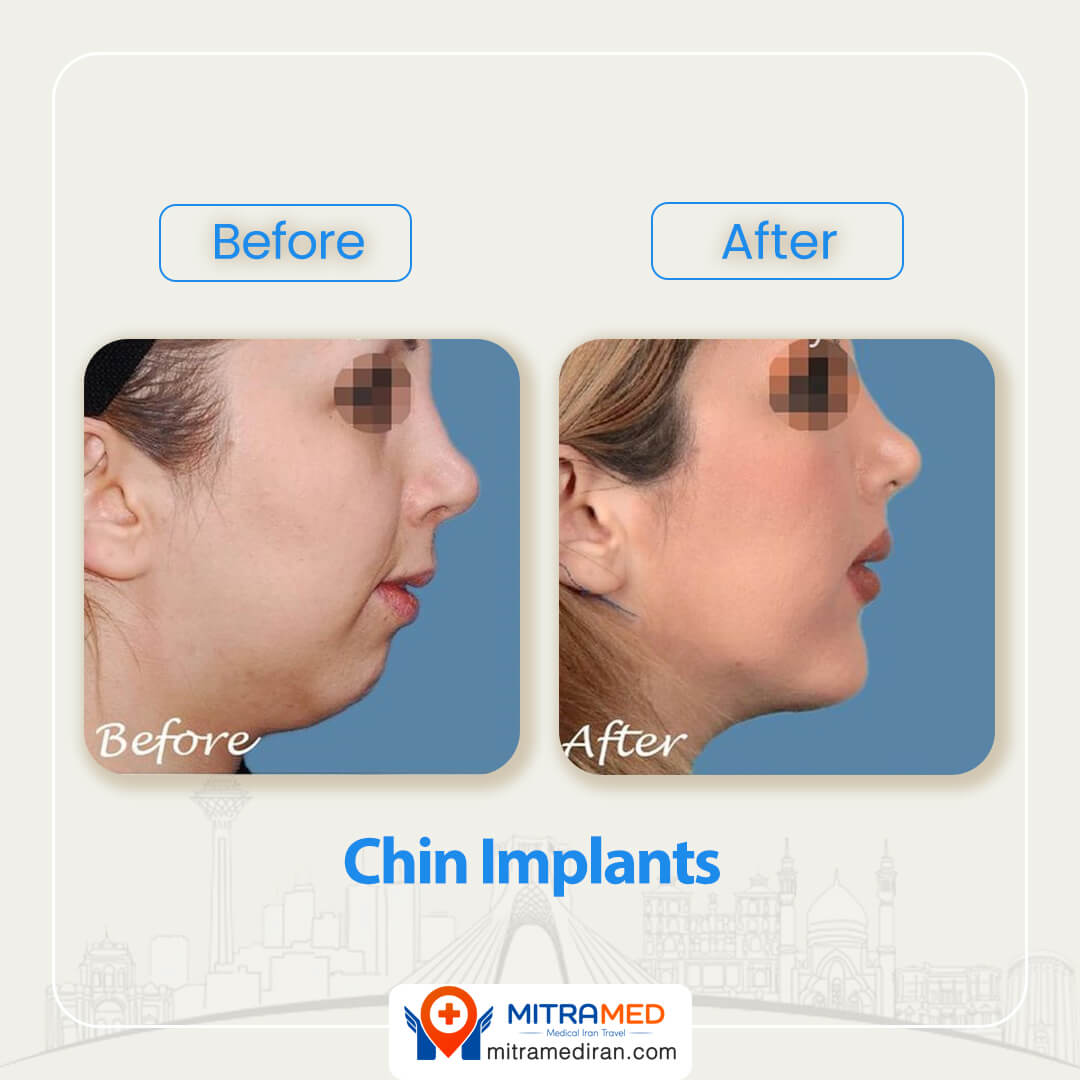 chin implants before after