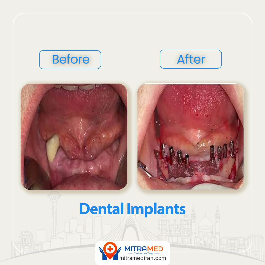 dental implants in Iran before after-1
