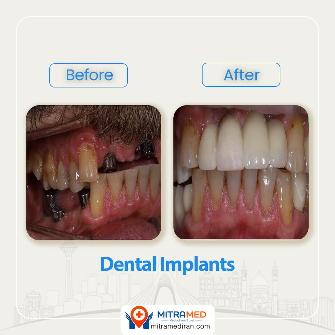 dental implants in Iran before after-2