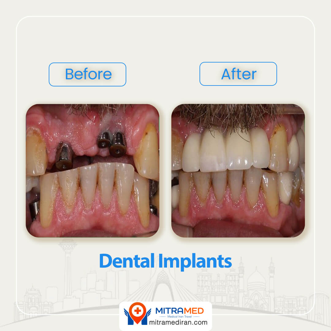 dental implants in Iran before after-3