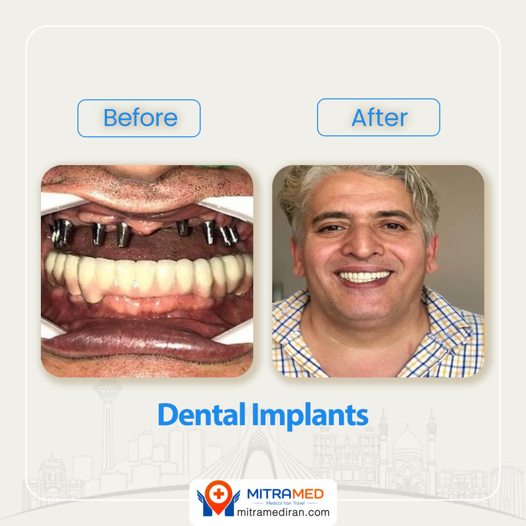 dental implants in Iran before after-4