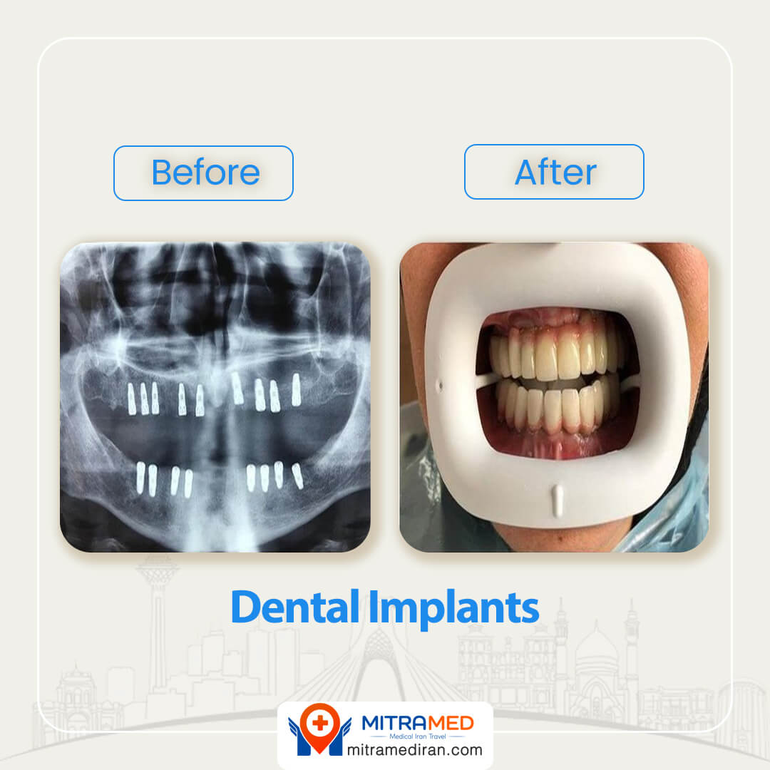 dental implants before after-5