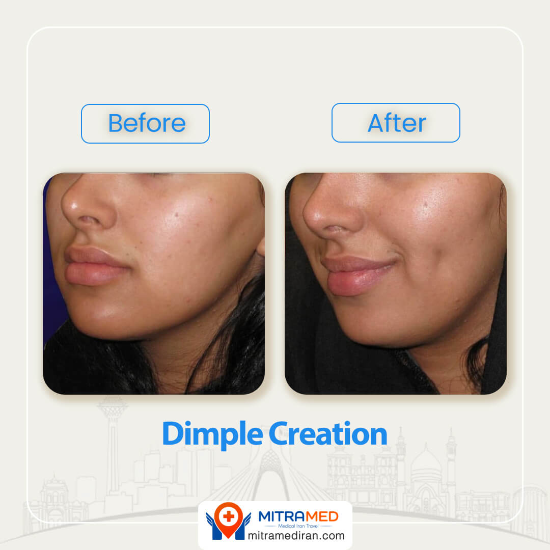 dimple creation before after-1