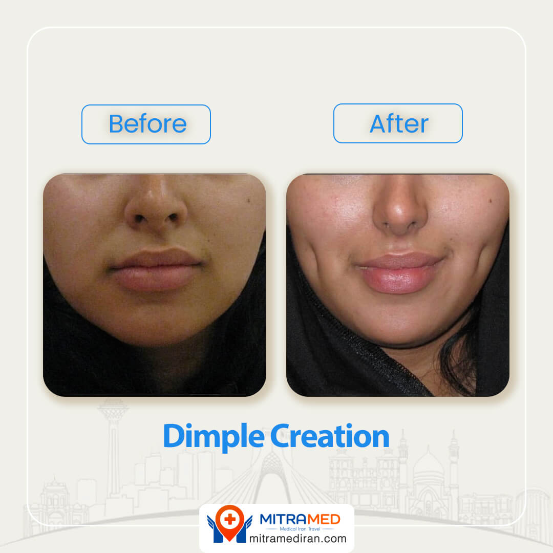 dimple creation before after-2