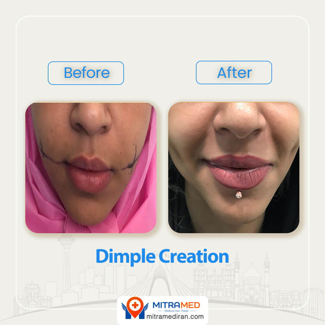 dimple creation before after-3