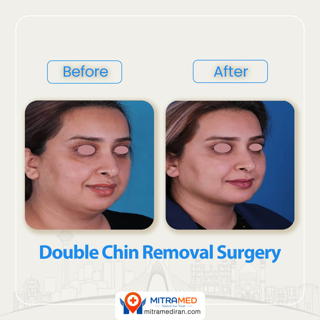 double chin surgery before after-2