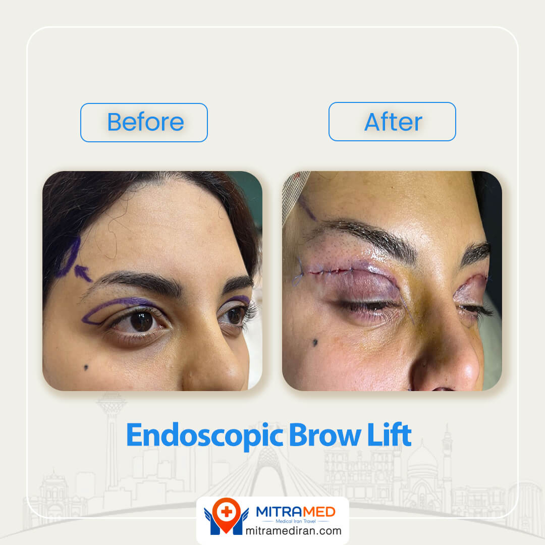 endoscopic brow lift before after-1