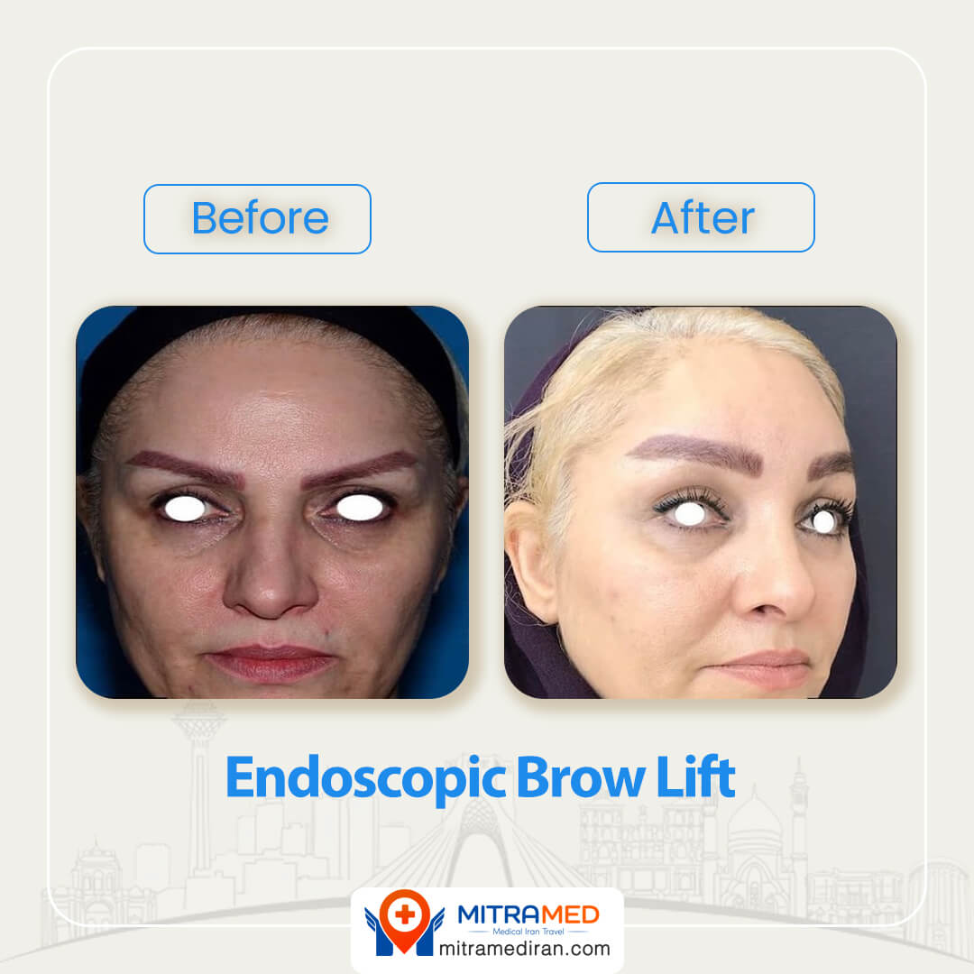 endoscopic brow lift before after-2