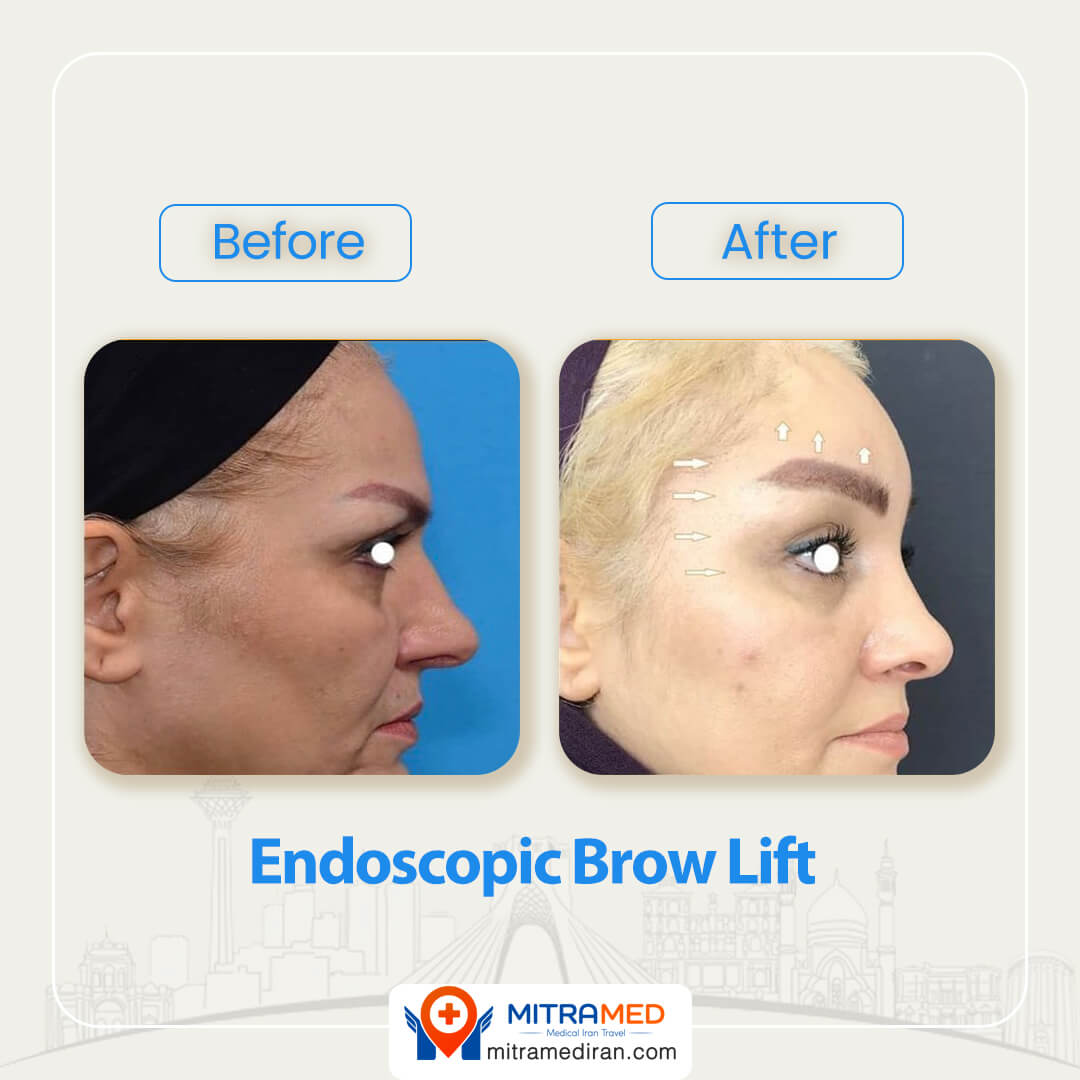 endoscopic brow lift before after-3