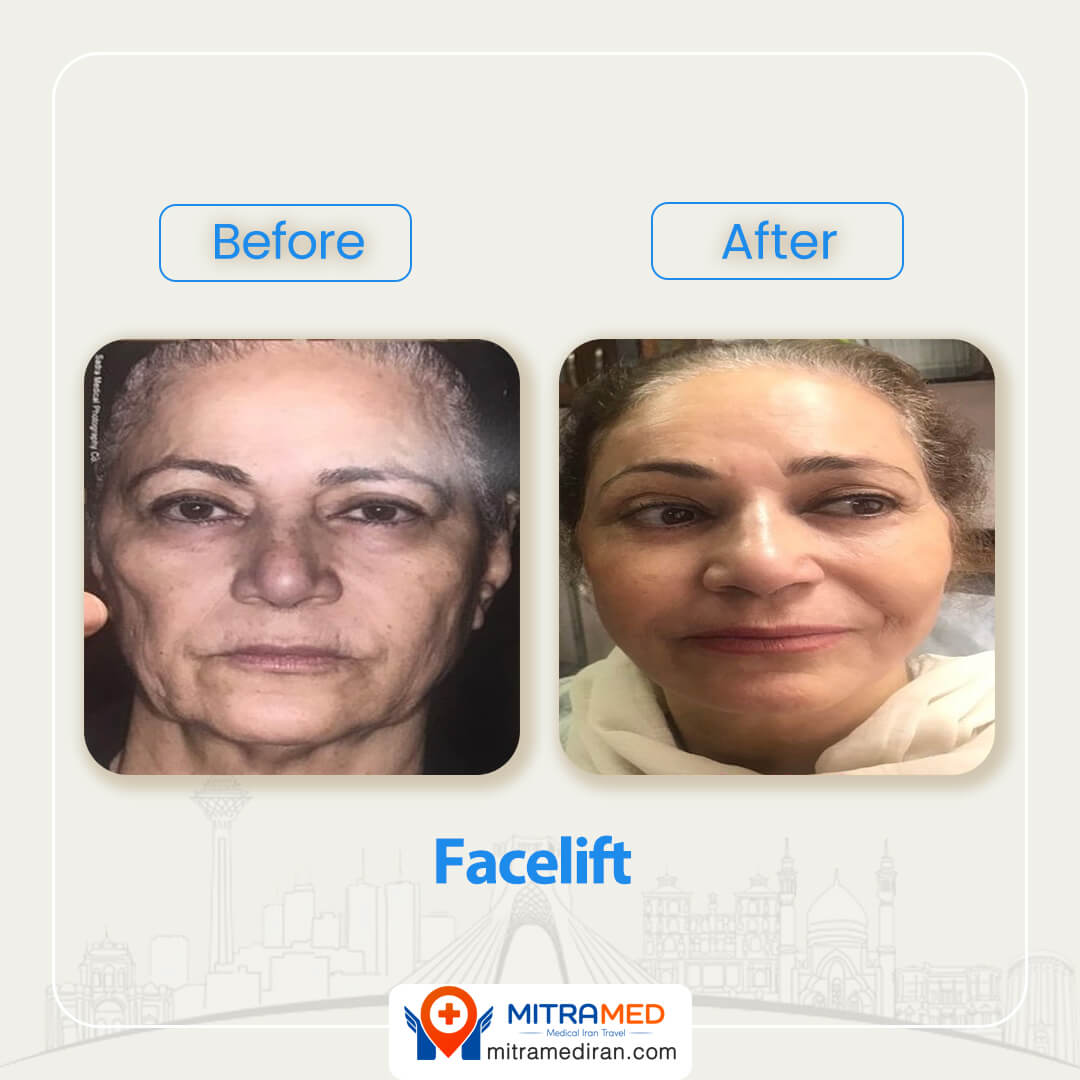 facelift before after-1