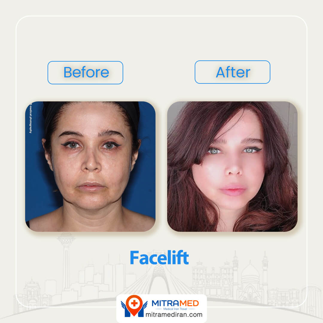 facelift before after-5