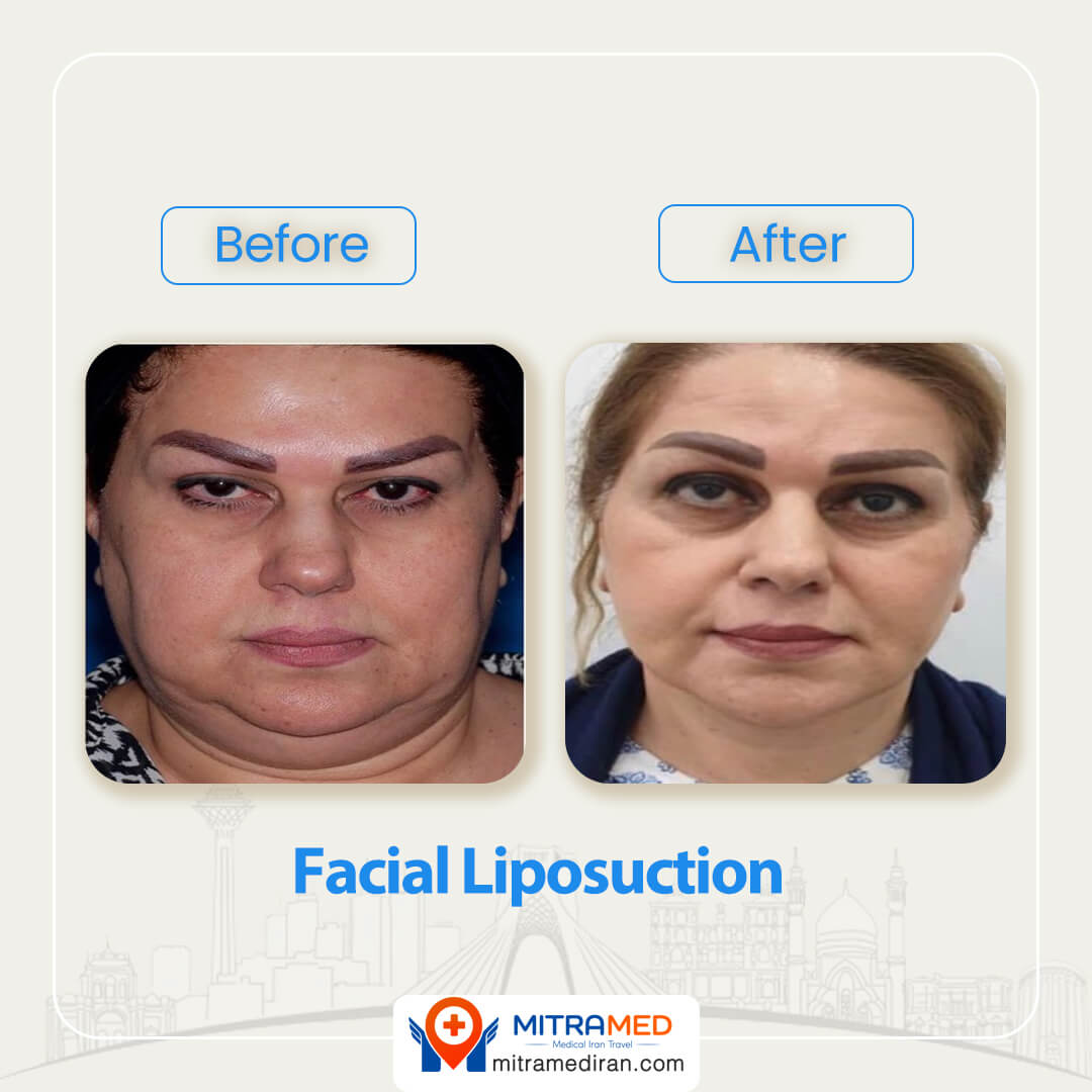 facial liposuction before after-1