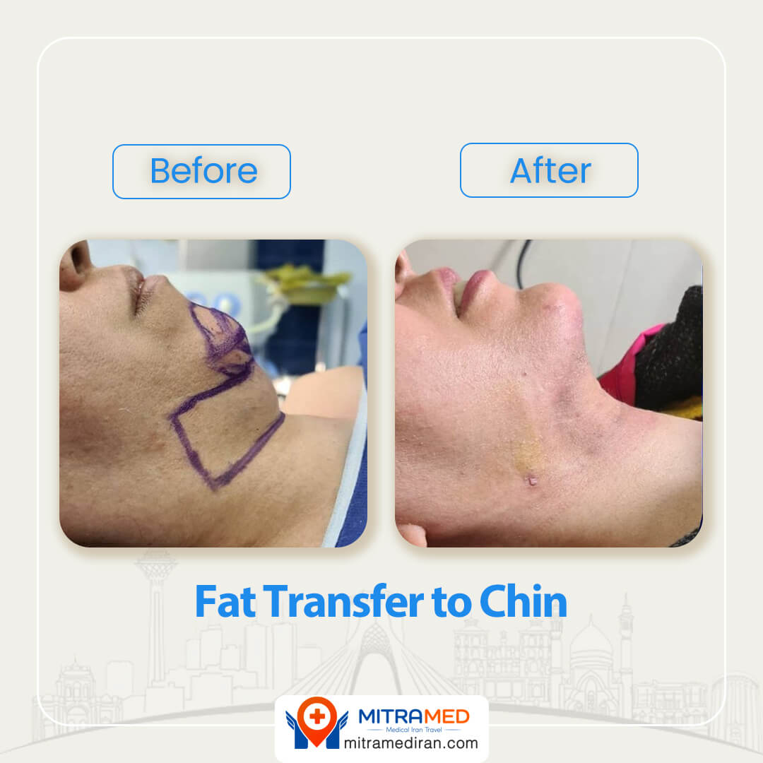 fat transfer to chin