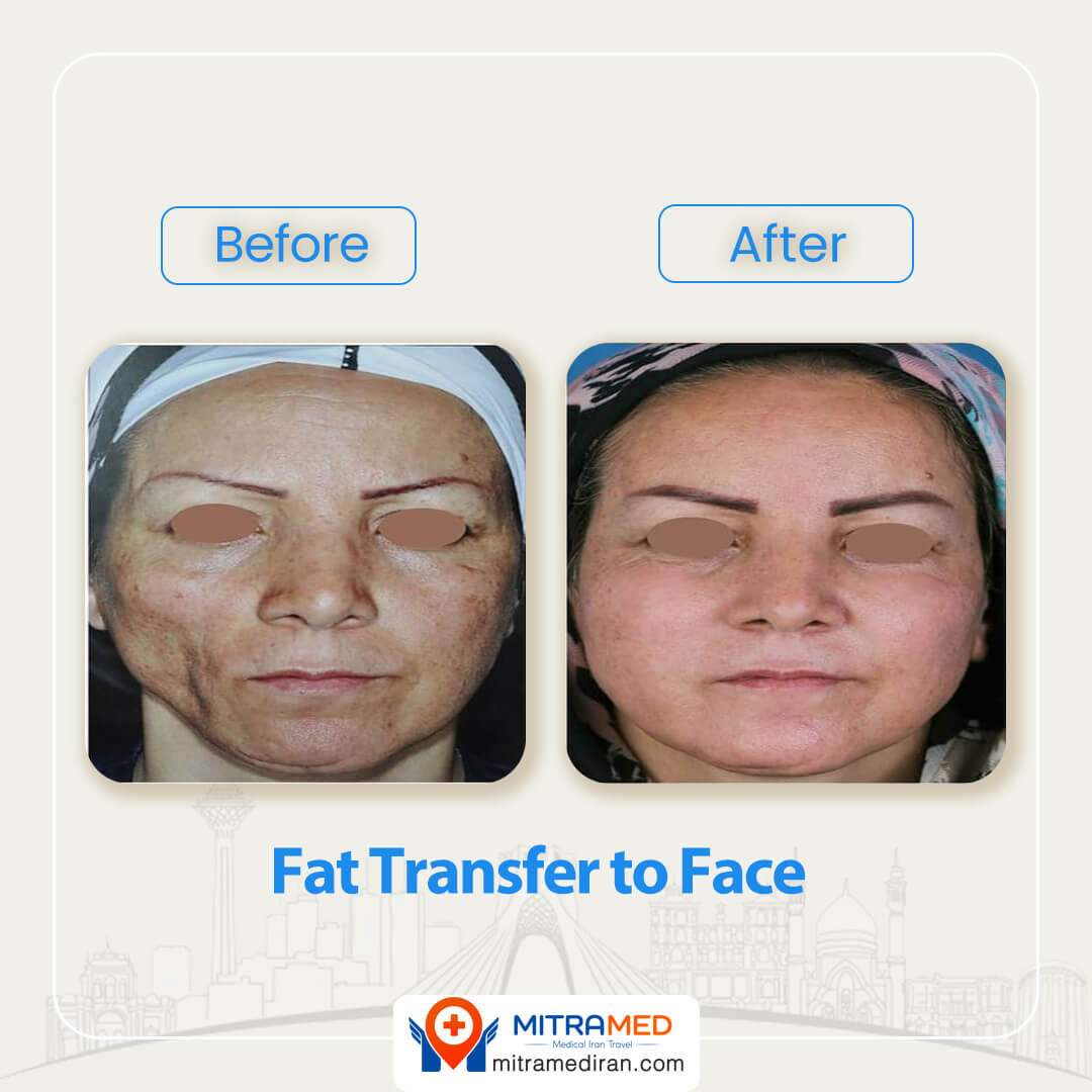 fat transfer to face before after-2