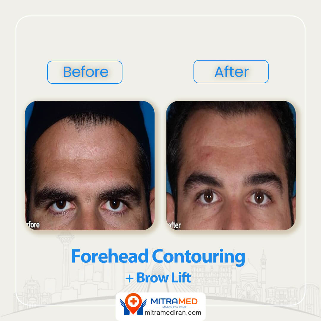 forehead contouring before after-1