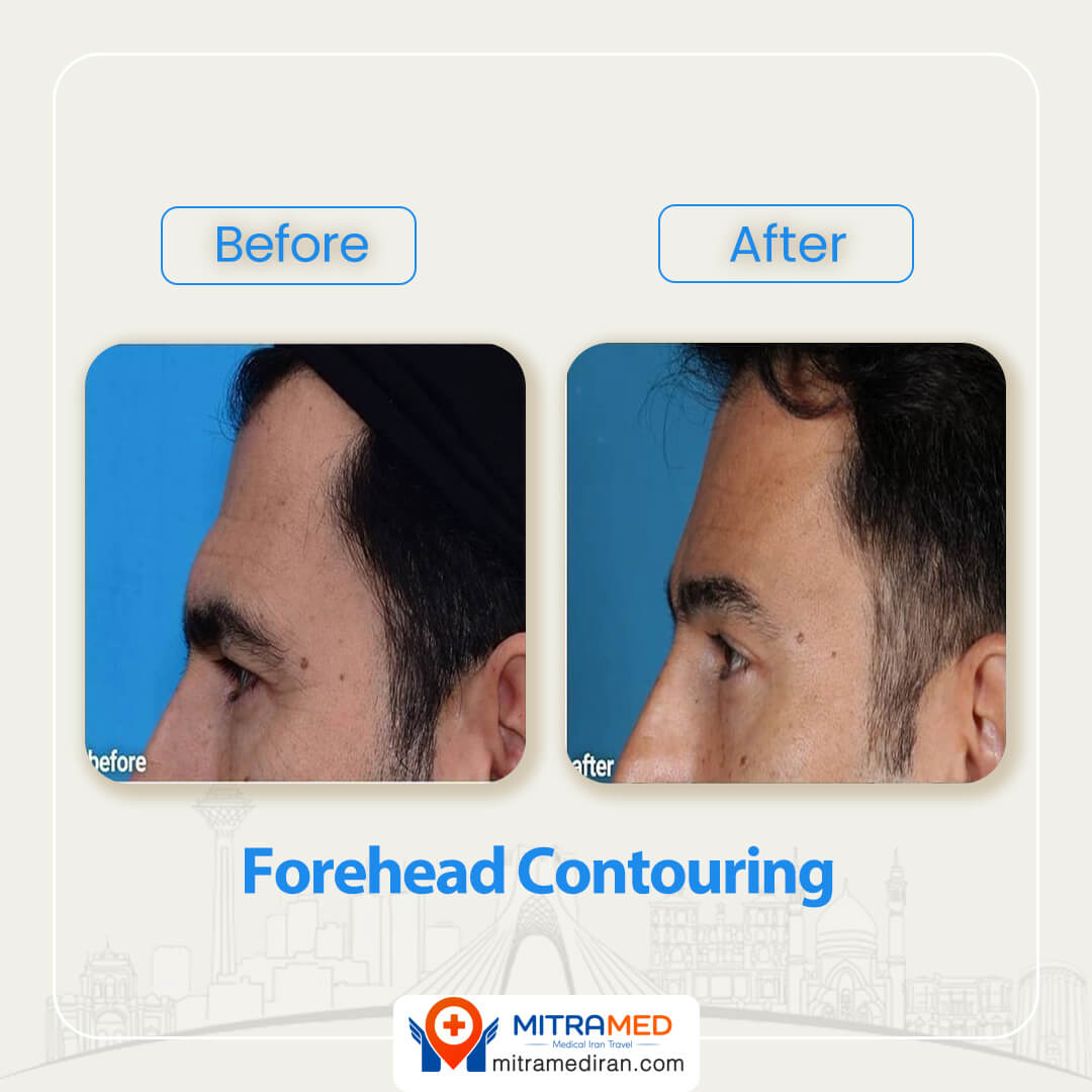 forehead contouring before after-2