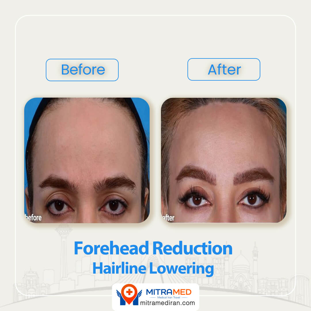 forehead reduction before after-1