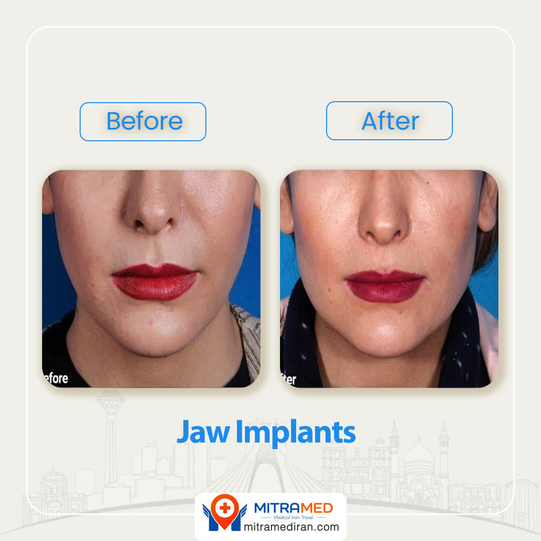 jaw implant before after-1