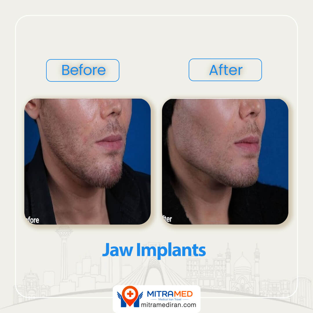 jaw implant before after-2