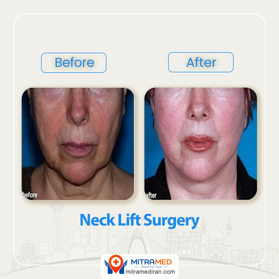 neck lift before after-1