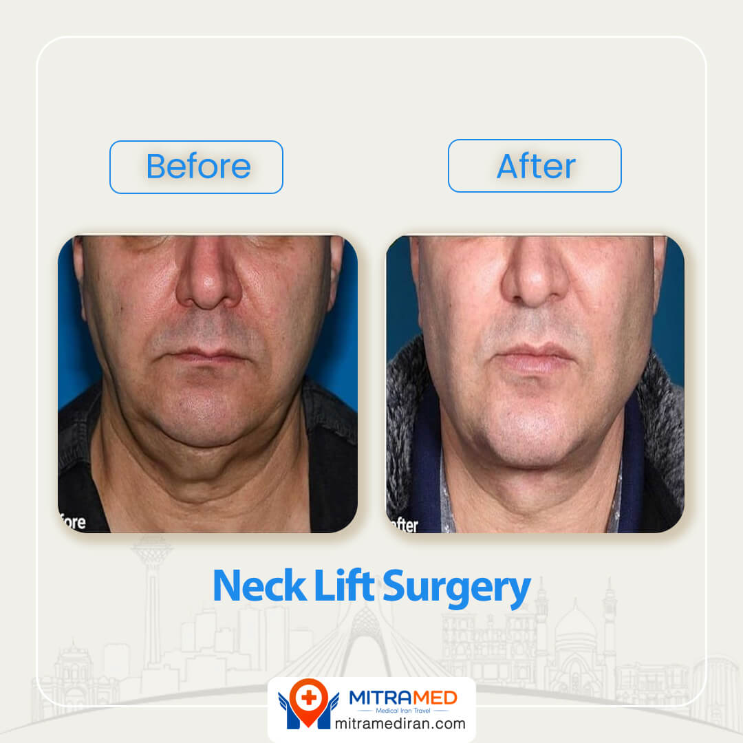 neck lift before after