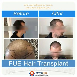 hair transplant before after2