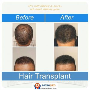 hair transplant before after3