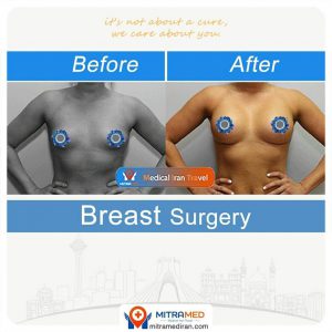 breast surgery before after photo10