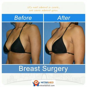 breast surgery before after photo11