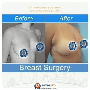 breast surgery before after photo12