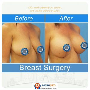 breast surgery before after photo16