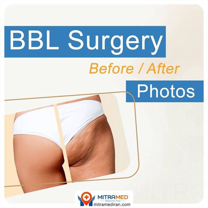 bbl before after