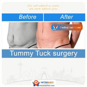abdominoplasty before after11