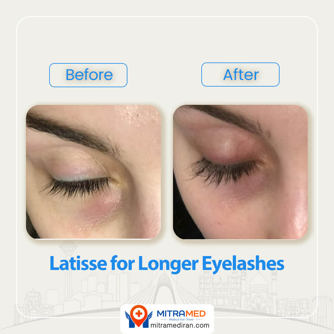 Latisse for Longer Eyelashes results