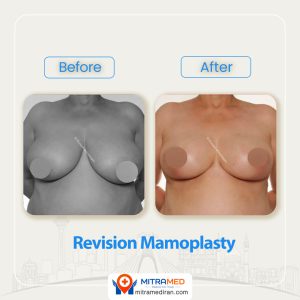 breast surgery before after10